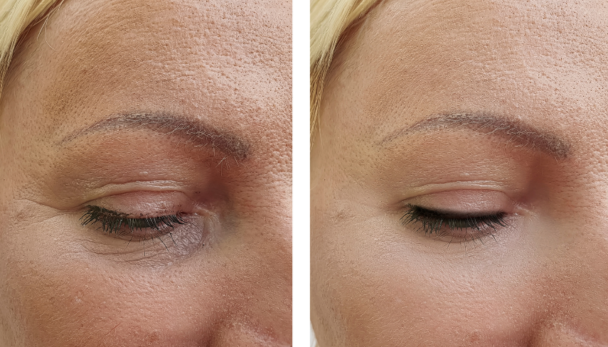 Before and after comparison of a woman's eye area on a white background