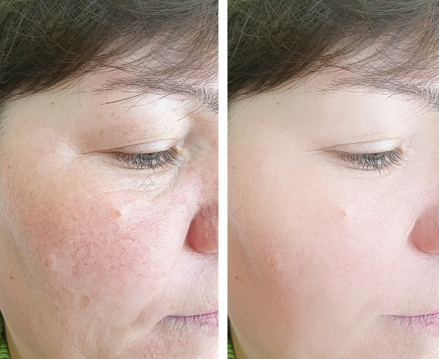 Before and after comparison of a person's face with visible skin texture changes.